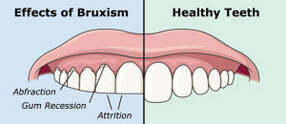 bruxism