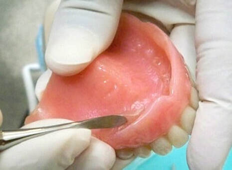 denture relines