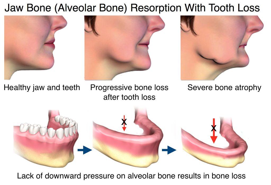 dentures bone resorption