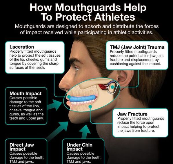 benefits of custom mouth guards