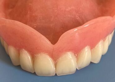 Upper dentures repaired and cleaned
