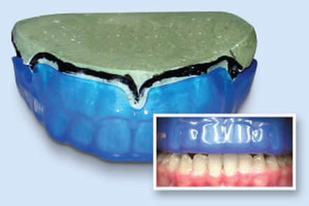 custom mouthguard on denture model