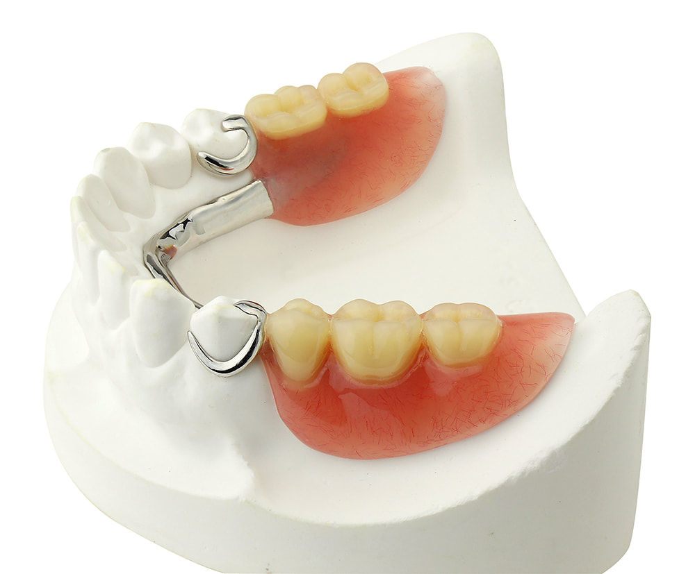 partial dentures repaired on model