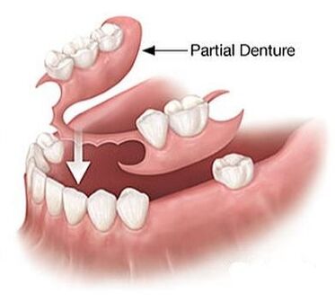 PARTIAL DENTURE REPAIR